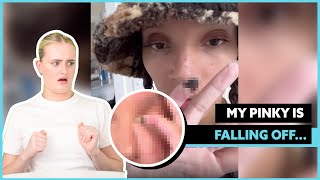 My Pinky Finger Is Falling Off! 😱 | STORYTRENDER