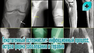 Гематогенный остеомиелит: инфекционный процесс, острая форма заболевания и терапия