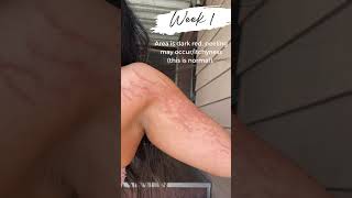Healing Process For Inkless Stretch Mark Treatment (WATCH TILL END) #youtubeshortsvideo #shortsfeed