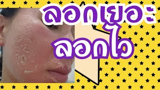 EP.51  #ผลัดเซลส์ผิว   วิธีทำให้หน้า  ลอกเยอะ// หน้าไม่ดำ//  ลอกไว// ใสทุกคน  (ทำตามได้เลย)