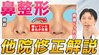 【他院修正】鼻整形を他院で受けられた方の修正症例をご紹介します