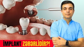 KEYFİYYƏTSİZ İMPLANTLAR | Əks-Təsirləri Nədir? | Üz-Çənə Cərrahı Dr. Rafiq Ibrahimov