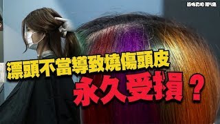 恐怖真相｜ 漂頭不當導致燒傷頭皮永久受損？｜脫髮｜頭皮受傷｜植髮