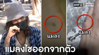 ป่วยประหลาด! สาวแมลงไชออกจากตัว เจ็บหมือนถูกกรีดร่าง | ข่าวเที่ยงช่องวัน | ข่าวช่องวัน