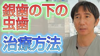 銀歯の下がひどい虫歯の時の虫歯治療方法とは？【埼玉県蓮田市東蓮見歯科医院】