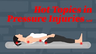 Hot Topics in Pressure Injuries and Wounds