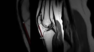 Patella alta and fatty impingement