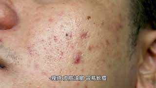 多囊卵巢综合征，PCOS 该如何调理（女性们最关心的妇科病）