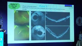 AIOC2023 PPP Vitreo Retinal Diseases  FP1497 topic  Phenotypical variation with age in CERKL gene re