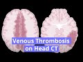 Venous Thrombosis on Head CT