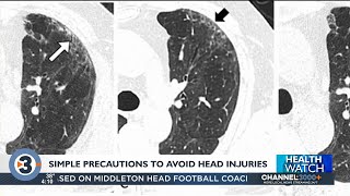 Simple precautions can prevent head injuries and concussions, UW Health expert says