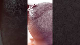 The Ultimate Solution For Hair Regrowth! | Hair Transplant Clinic | Dadu Medical Centre