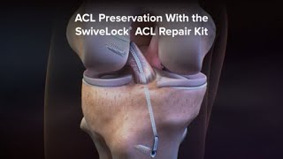 ACL Preservation With the SwiveLock® ACL Repair Kit