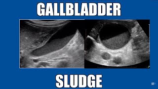 Sonoquickies - Gallbladder Sludge