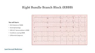 Right Bundle Branch Block (RBBB) - Features, Electrophysiology, Causes \u0026 Differential Diagnosis