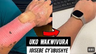 DORE UKO WAKWIVURA IGISEBE CY'UBUSHYE MU BURYO BWOROSHYE CYANE