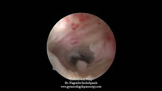 Endocervical polyp