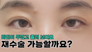 온라인성형상담) 재수술 가능할까?(눈 풀림, 졸려 보이는 눈, 두꺼운 라인)