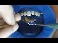 variolink® esthetic lc cementation of a veneer made of ips e.max® en ivoclar