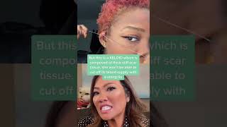Keloids Cannot Be Removed With a String, unfortunately. #drpimplepopper#DPPreacts