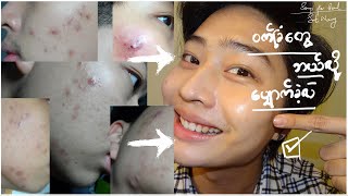 Acne Journey