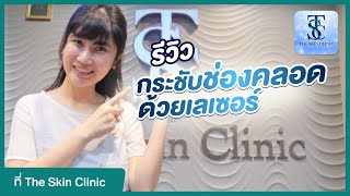 รีวิว รีแพร์ด้วยเลเซอร์ เครื่อง Indiba เลเซอร์กระชับช่องคลอด ที่ The Skin Clinic | HDreview