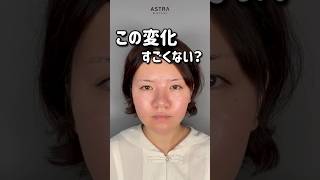 【鼻整形すごくない❔】 #アストラビューティクリニック #美容 #忘れ鼻 #鼻整形