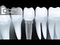 How are Dental Implants for mandibular teeth better than denture? - Dr. Sangeeta Honnur