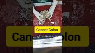 😱cancar colon specimen 😨| #specimen #museum #uterusproblem #cancertumor  #colon #colonoscopy #biopsy