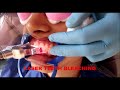 LASER TEETH BLEACHING TEETH WHITENING  IN OFFICE BLEACH KONDAPUR AND LINGAMPALLI VK DENTAL CLINIC