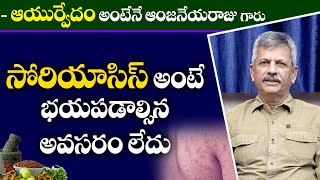 Best medicine for psoriasis || సోరియాసిస్ అంటే భయపడాల్సిన అవసరం లేదు | B. Anjaneya Raju