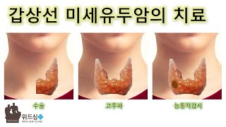 갑상선 미세유두암의 치료 1. 개요