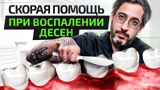 Почему кровоточат десны при чистке зубов. Что делать?