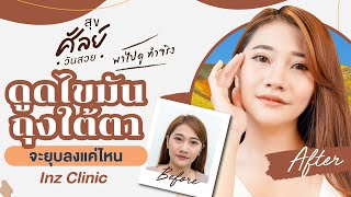 ดูดไขมันกำจัดถุงใต้ตา จะยุบลงแค่ไหน ไปดู!