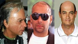 Famous Bollywood Stars Who Done Hair Transplant Surgery | Shocking