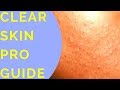 How To Clear Skin Congestion | Blackheads | Whiteheads | Bumpy Skin