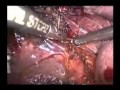 Control of Liver bed lushcka duct by clipping