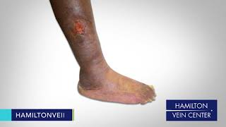 Hamilton Vein - Austin TV Commercial - Symptom Ulcer