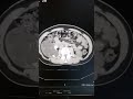 CT KUB #Hydronephrosis #Calculi #CT KUB Pathology #How to ct kub, #Kidney stone,