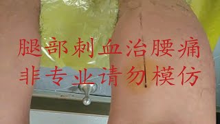 腿部刺血，腰部立刻轻松！