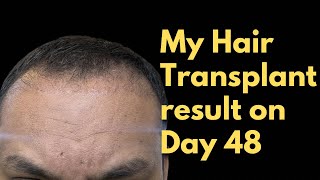 My Hair Transplant result on Day 48 | Vaarun Tiwari #hairtransplant