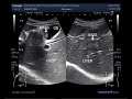 Ultrasound Video showing Gallbladder Mass with a metastatic lesion in the Liver.