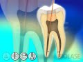 endodontic root canal disinfection waterlase laser dentistry