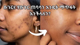 5 ቡጉርና የቡጉር ጠባሳን የሚያጠፉ የskincare ግብአቶች #habeshaselfcare