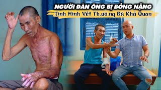 THÉP TẶNG CHÚ 20 TRIỆU ĐI SÀI GÒN CHỮA TRỊ BỊ BỎNG KẾT QUẢ RẤT KHẢ QUAN