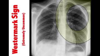 Radiographic Findings of Pulmonary Embolism - CME4Life PANRE Pearl # 23