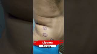 Lipoma | Lipoma Removal | Multipal Lipoma Removal #short #shortvideo