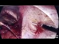 Laparoscopic Transabdominal preperitoneal hernia repair(TAPP) Right inguinal hernia