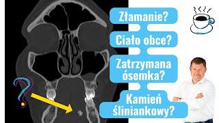 Złamanie, Ciało Obce, Zatrzymana Ósemka, Kamień Śliniankowy?