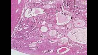 Histopathology Endometrium--Endometrial polyp